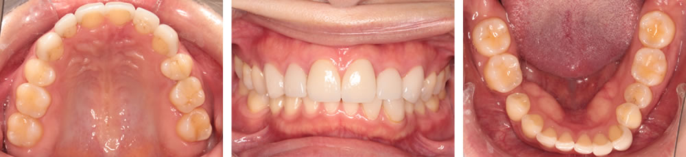 抜歯矯正で健康被害が生じたケースの改善